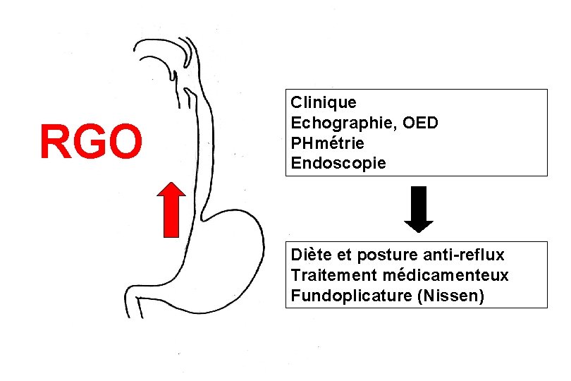 Schéma simple RGO Clinique Echographie, OED PHmétrie Endoscopie Diète et posture anti-reflux Traitement médicamenteux