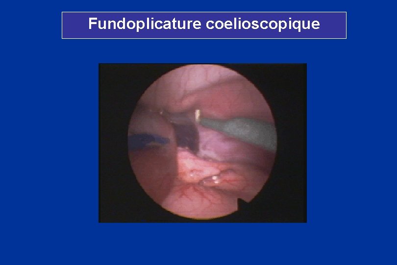 Fundoplicature coelioscopique 