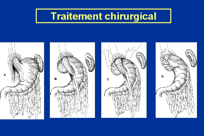Traitement chirurgical 