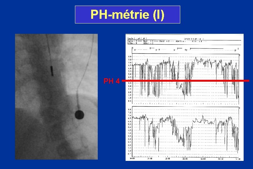 PH-métrie (I) PH 4 