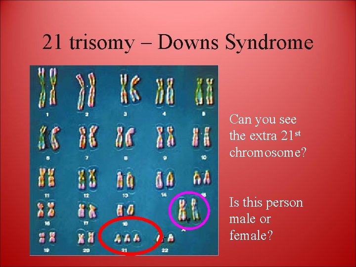 21 trisomy – Downs Syndrome Can you see the extra 21 st chromosome? Is