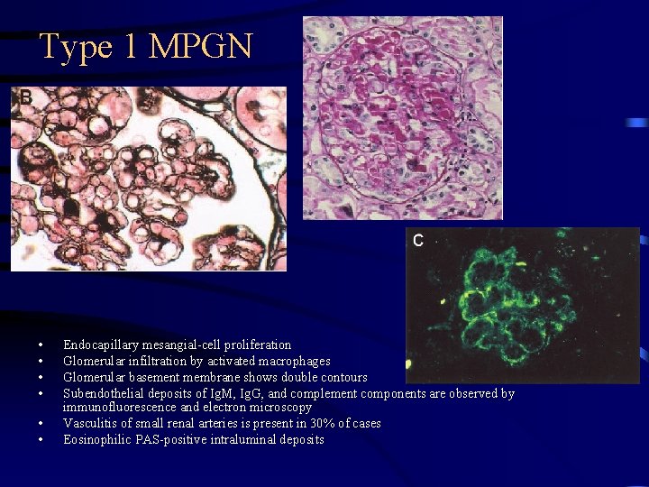 Type 1 MPGN • • • Endocapillary mesangial-cell proliferation Glomerular infiltration by activated macrophages