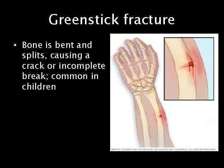 Greenstick fracture • Bone is bent and splits, causing a crack or incomplete break;