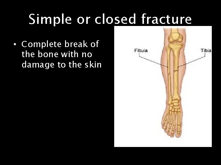 Simple or closed fracture • Complete break of the bone with no damage to