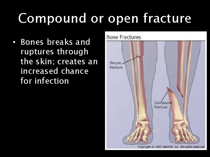 Compound or open fracture • Bones breaks and ruptures through the skin; creates an