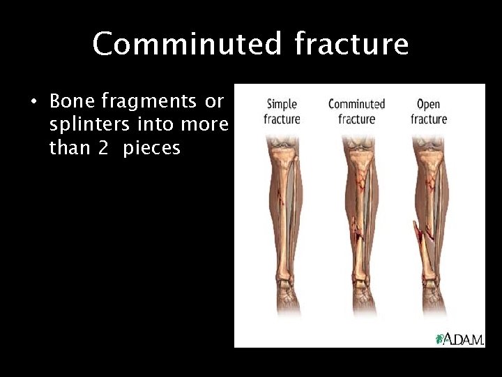 Comminuted fracture • Bone fragments or splinters into more than 2 pieces 