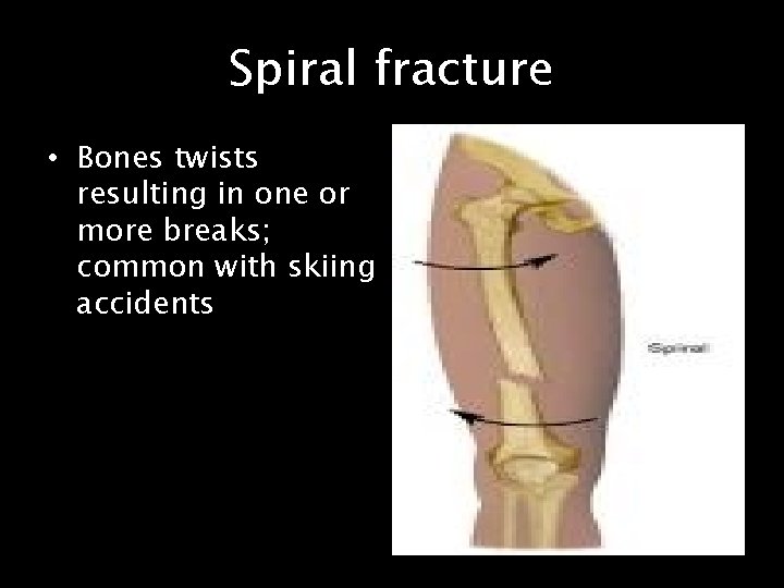 Spiral fracture • Bones twists resulting in one or more breaks; common with skiing