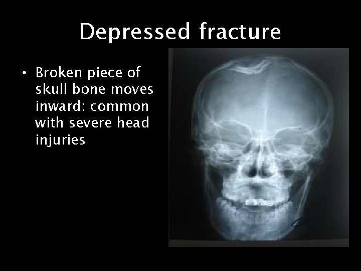 Depressed fracture • Broken piece of skull bone moves inward: common with severe head