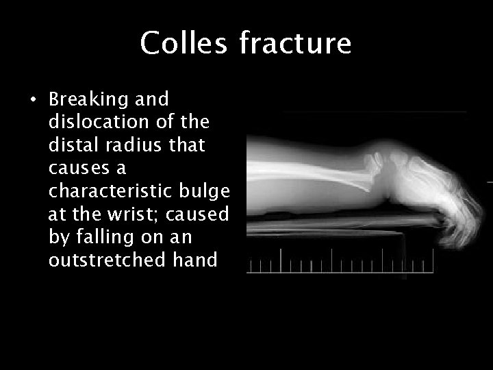 Colles fracture • Breaking and dislocation of the distal radius that causes a characteristic