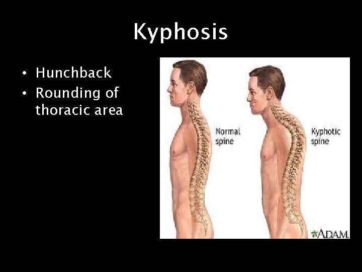 Kyphosis • Hunchback • Rounding of thoracic area 