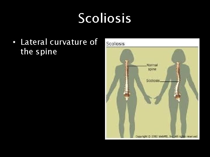 Scoliosis • Lateral curvature of the spine 