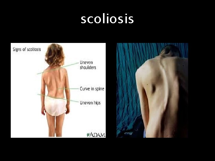 scoliosis 