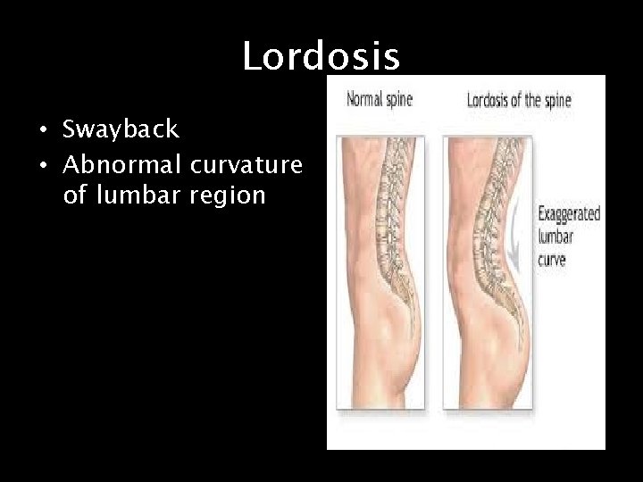 Lordosis • Swayback • Abnormal curvature of lumbar region 