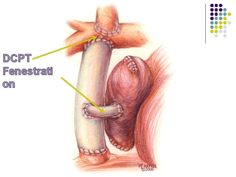 DCPT Fenestrati on 