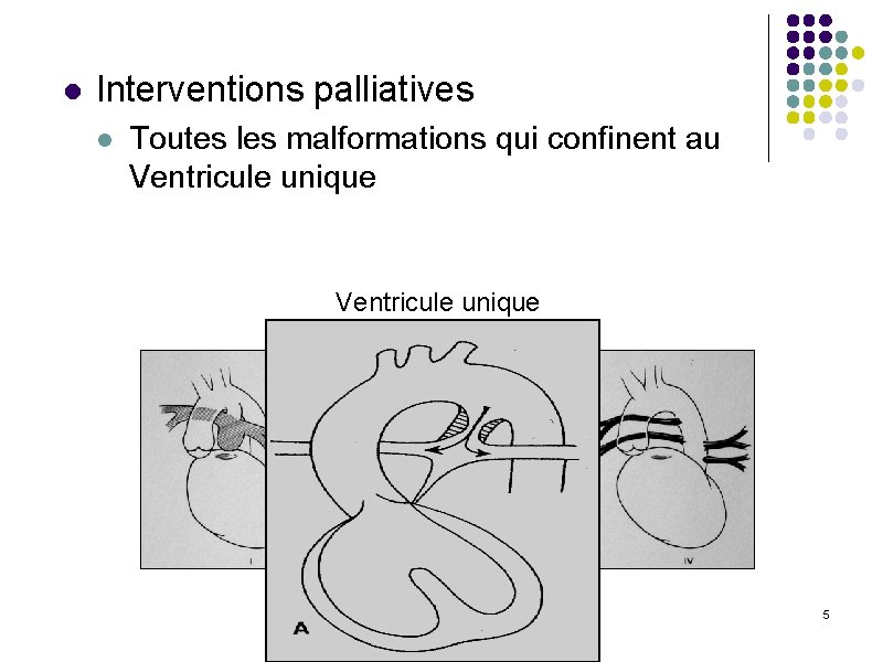 l Interventions palliatives l Toutes les malformations qui confinent au Ventricule unique APSO 5