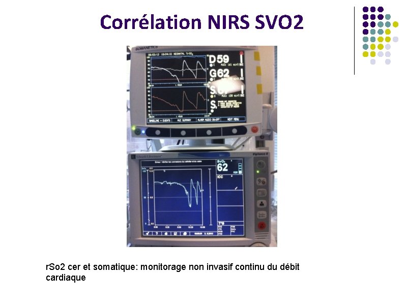 Corrélation NIRS SVO 2 r. So 2 cer et somatique: monitorage non invasif continu
