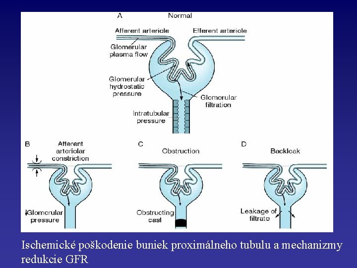 Ischemické poškodenie buniek proximálneho tubulu a mechanizmy redukcie GFR 