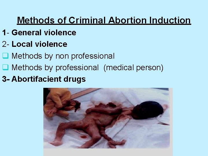 Methods of Criminal Abortion Induction 1 - General violence 2 - Local violence q