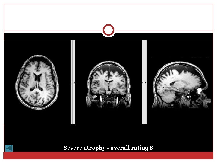 Severe atrophy - overall rating 8 