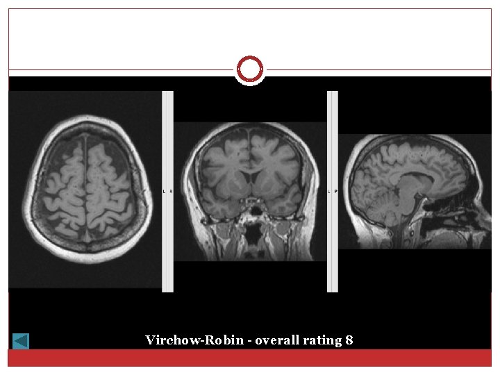 Virchow-Robin - overall rating 8 