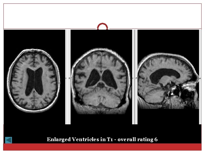 Enlarged Ventricles in T 1 - overall rating 6 