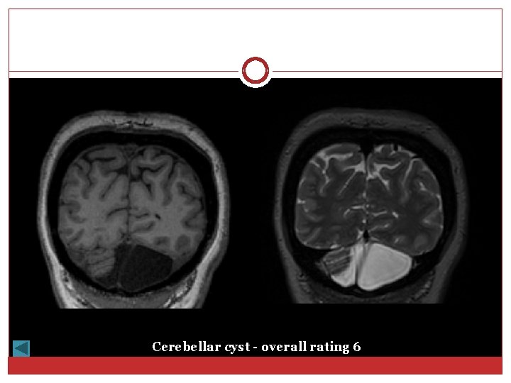 Cerebellar cyst - overall rating 6 