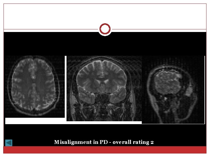 Misalignment in PD - overall rating 2 