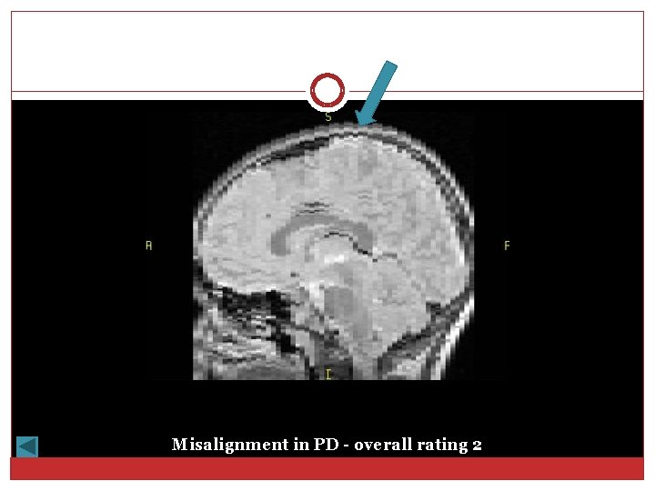 Misalignment in PD - overall rating 2 