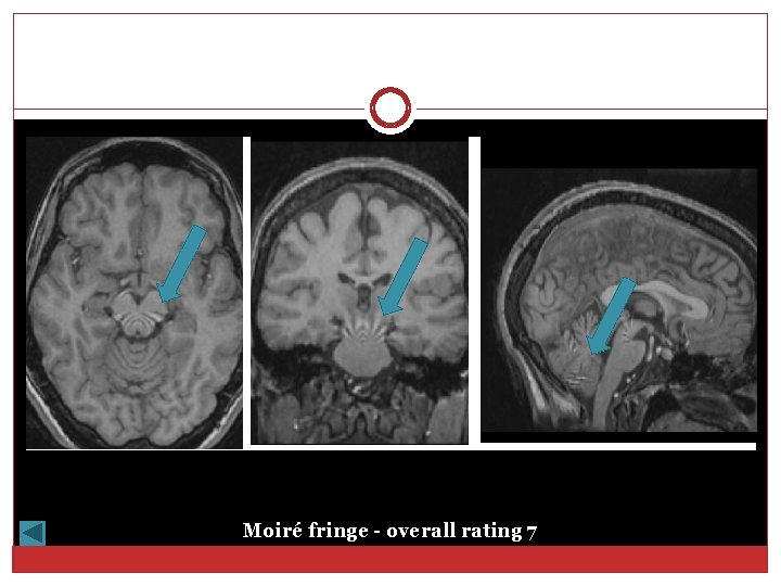 Moiré fringe - overall rating 7 