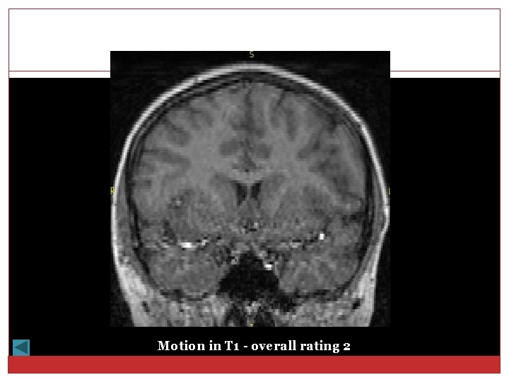 Motion in T 1 - overall rating 2 