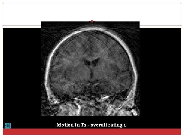 Motion in T 1 - overall rating 1 