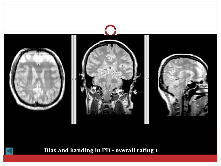 Bias and banding in PD - overall rating 1 