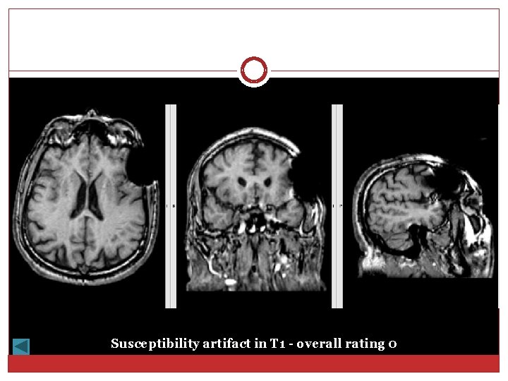 Susceptibility artifact in T 1 - overall rating 0 