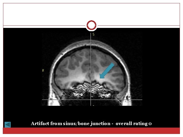 Artifact from sinus/bone junction - overall rating 0 
