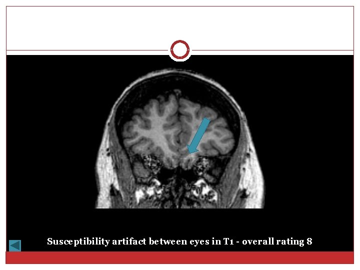Susceptibility artifact between eyes in T 1 - overall rating 8 
