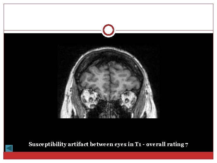 Susceptibility artifact between eyes in T 1 - overall rating 7 
