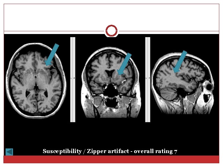 Susceptibility / Zipper artifact - overall rating 7 
