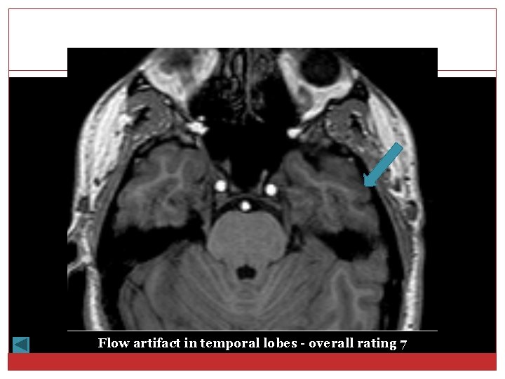 Flow artifact in temporal lobes - overall rating 7 