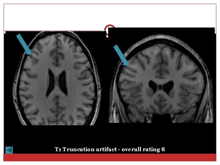 T 1 Truncation artifact - overall rating 8 