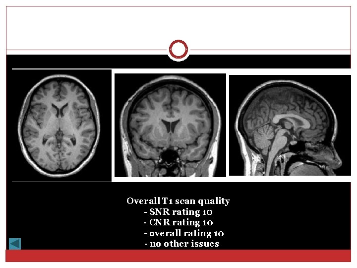 Overall T 1 scan quality - SNR rating 10 - CNR rating 10 -