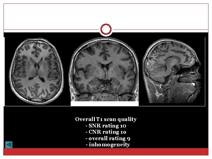 Overall T 1 scan quality - SNR rating 10 - CNR rating 1 o