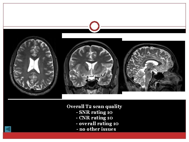 Overall T 2 scan quality - SNR rating 10 - CNR rating 10 -