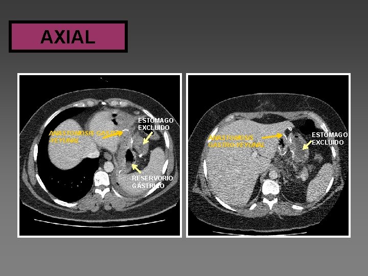 AXIAL ANASTOMOSIS GASTRO -YEYUNAL ESTÓMAGO EXCLUIDO ANASTOMOSIS GASTRO-YEYUNAL RESERVORIO GÁSTRICO ESTÓMAGO EXCLUIDO 