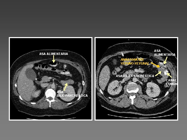 ASA ALIMENTARIA ANASTOMOSIS YEYUNO-YEYUNAL colon ASA BILIOPANCREÁTICA CANAL COMÚN ASA BILIOPANCREÁTICA 