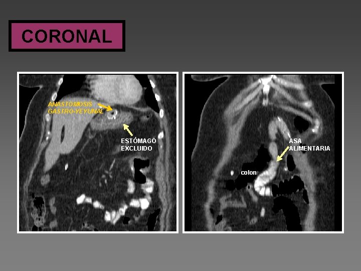 CORONAL ANASTOMOSIS GASTRO-YEYUNAL ESTÓMAGO EXCLUIDO ASA ALIMENTARIA colon 