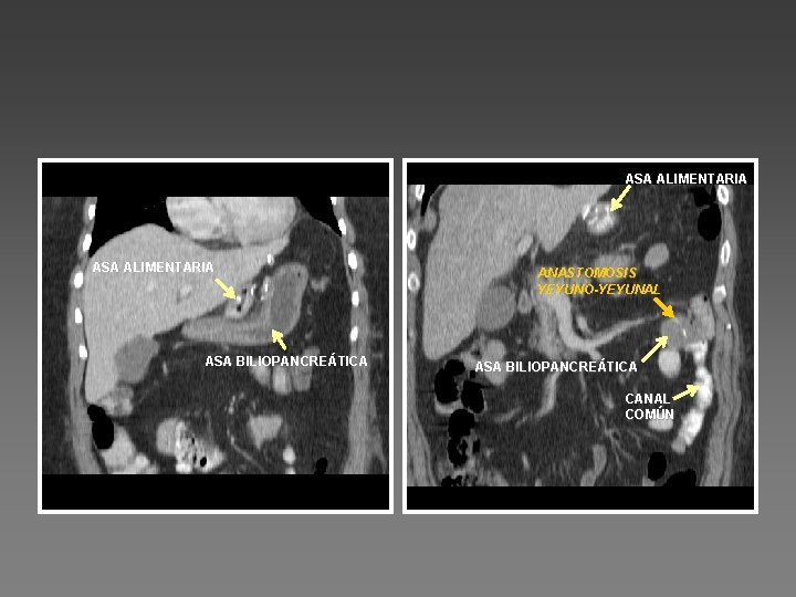 ASA ALIMENTARIA ASA BILIOPANCREÁTICA ANASTOMOSIS YEYUNO-YEYUNAL ASA BILIOPANCREÁTICA CANAL COMÚN 