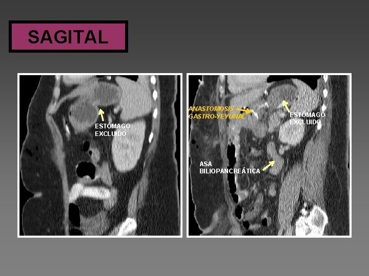 SAGITAL ANASTOMOSIS GASTRO-YEYUNAL ESTÓMAGO EXCLUIDO ASA BILIOPANCREÁTICA ESTÓMAGO EXCLUIDO 
