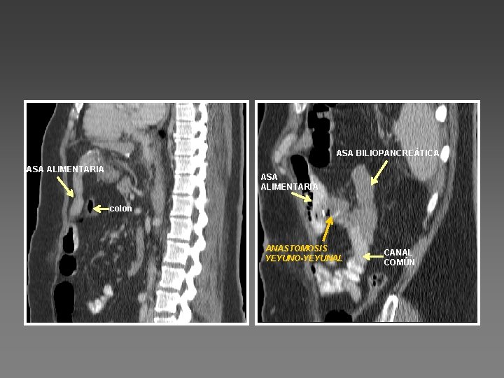 ASA BILIOPANCREÁTICA ASA ALIMENTARIA colon ANASTOMOSIS YEYUNO-YEYUNAL CANAL COMÚN 