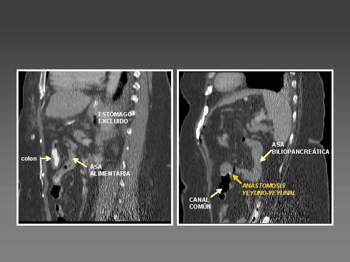 ESTÓMAGO EXCLUIDO ASA BILIOPANCREÁTICA colon ASA ALIMENTARIA ANASTOMOSIS YEYUNO-YEYUNAL CANAL COMÚN 
