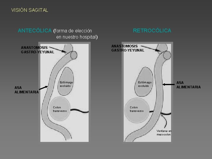 VISIÓN SAGITAL ANTECÓLICA (forma de elección RETROCÓLICA en nuestro hospital) ANASTOMOSIS GASTRO-YEYUNAL ASA ALIMENTARIA